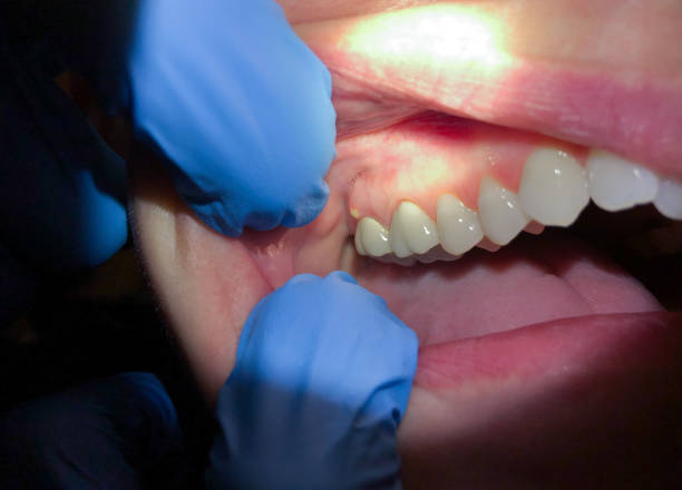 Best Emergency Dental Extractions in New Castle, CO