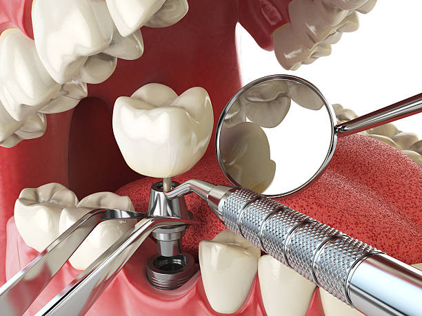 Best Broken or Cracked Tooth Emergency Dentist in New Castle, CO